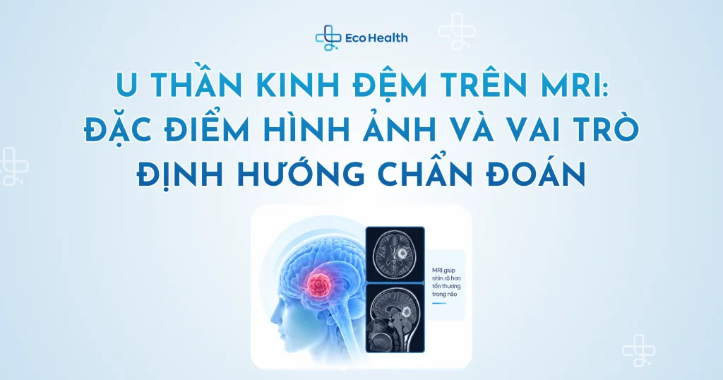 U thần kinh đệm trên MRI: đặc điểm hình ảnh và vai trò định hướng chẩn đoán